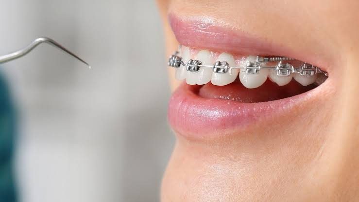 Dental Braces in Amritsar