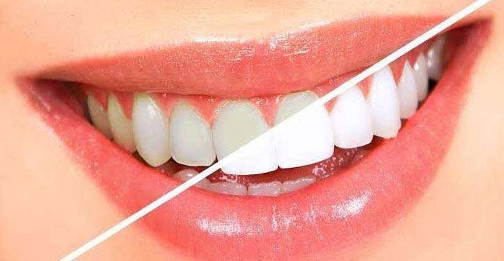 Teeth Whitening In Amritsar