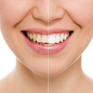 Teeth Whitening In Amritsar